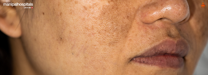 reduce hyperpigmentation skin