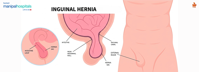 inguinal hernia surgery