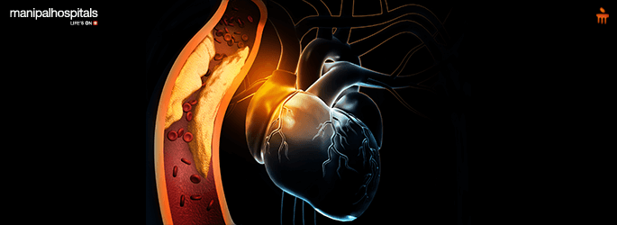 Does cholesterol cause heart attacks?