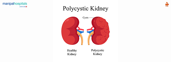 polycystic kidney disease symptoms