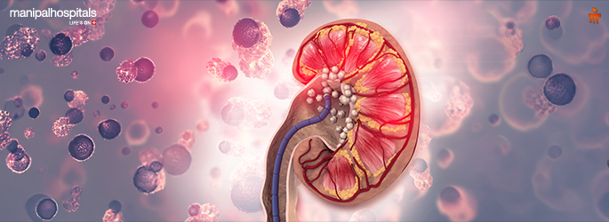 kidney stone prevention diet