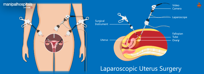 Laparoscopic Surgery: Benefits, Risks, and Recovery Tips