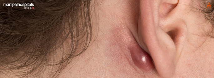 Lump Behind Ear: Causes, Diagnosis and Treatment