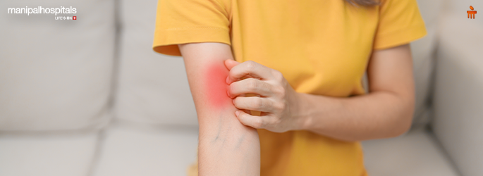 Lupus symptoms