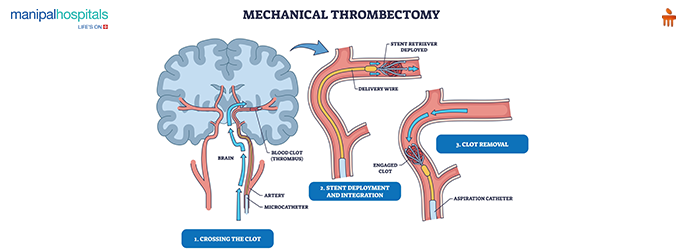 mechanical thrombectomy