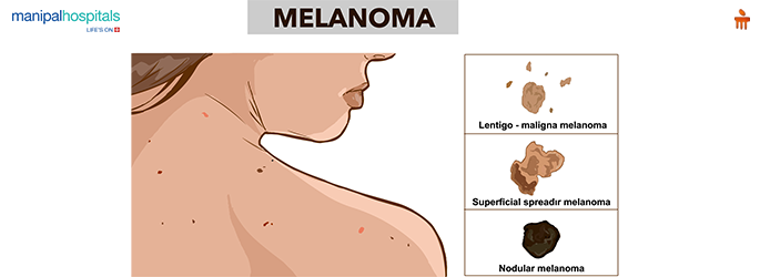 Melanoma Skin Cancer
