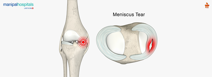meniscus tear treatment