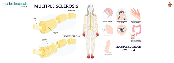 multiple sclerosis treatment