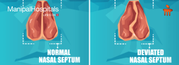 Deviated Nasal Septum Causes And Cures