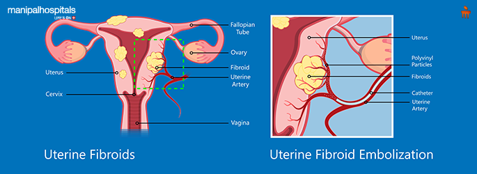 ovarian cancer
