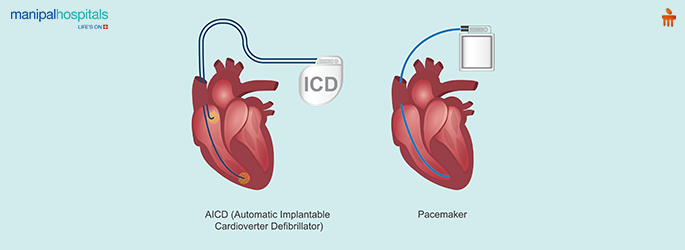 pacemaker surgery