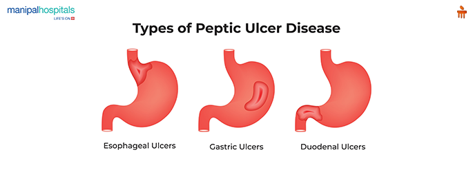 peptic ulcer symptoms