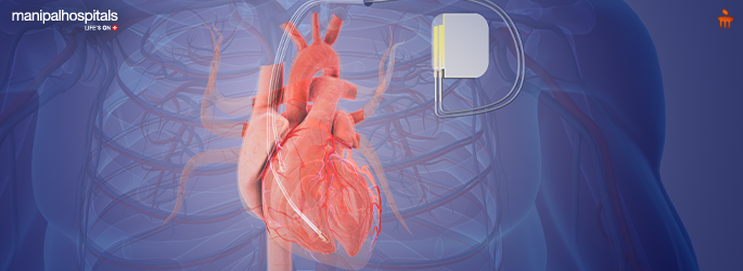 Permanent Pacemaker Implantation