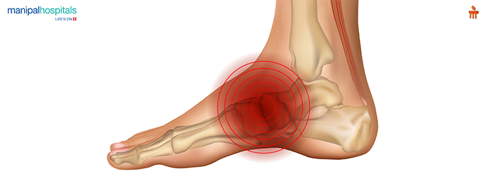 Foot Arch Pain Causes & Relief