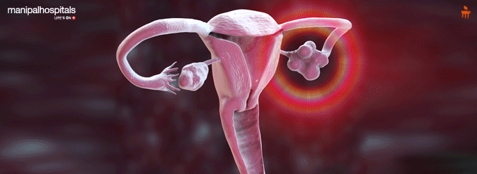 Polycystic Ovarian Disease treatment in Mangalore