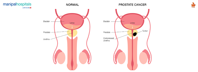 Prostate Cancer Symptoms