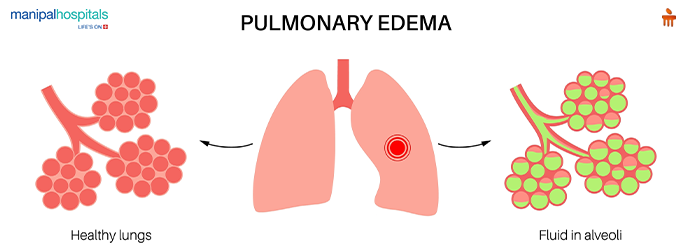 pulmonary edema causes​