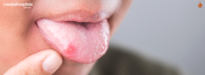 Quick Relief Tips for Tongue Ulcer