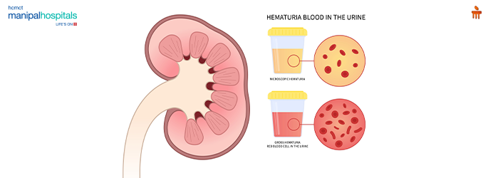 reasons for blood in urine