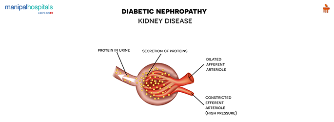 Reclaiming Kidney Health: Innovative Approaches to Treating Diabetic Nephropathy