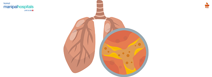 Top 10 Natural Remedies to Get Rid of Lung Mucus Fast