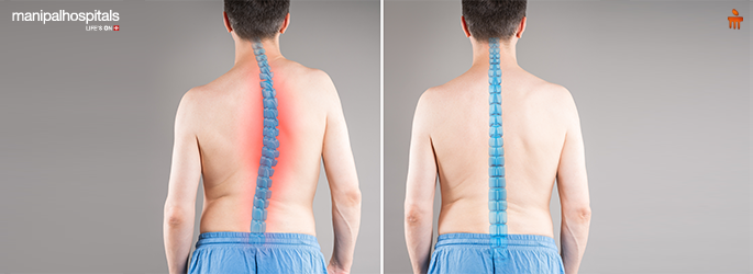 What Is Scoliosis? Meaning, Causes, Symptoms, and Diagnosis Explained What Is Scoliosis? Meaning, Causes, Symptoms, and Diagnosis Explained