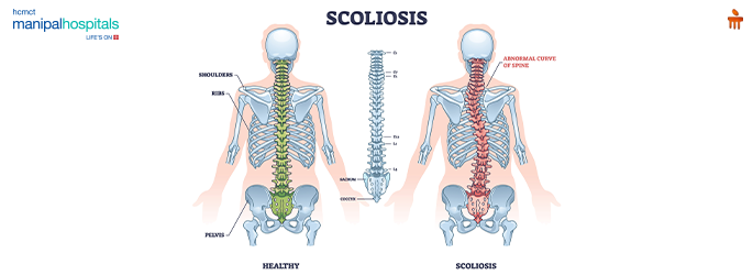 scoliosis causes