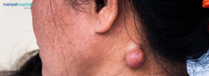 Sebaceous Cyst Symptoms