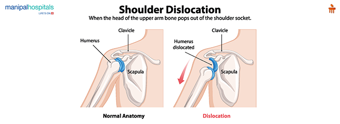 Shoulder injuries, rotator cuff tear, dislocation and treatment
