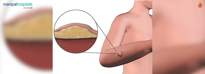 Soft Tissue Sarcomas: Symptoms, Types, Stages and Treatments