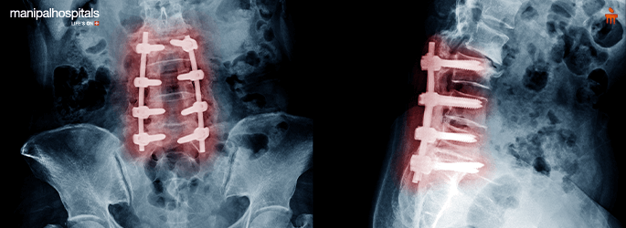 spinal fusion surgery types procedure and recovery