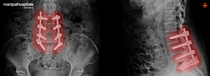 Spinal Decompression Surgery