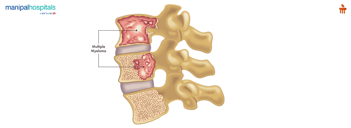 Spine Infections treatment in Old Airport Road