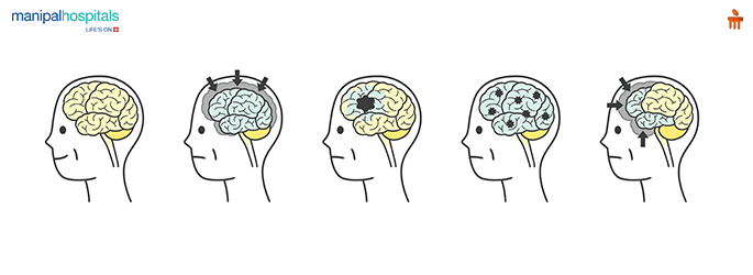 stiff person syndrome