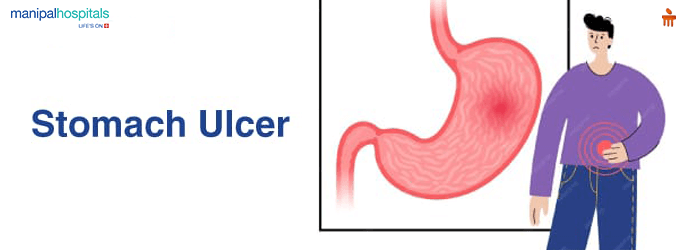 Stomach Ulcers and What You Can Do About Them