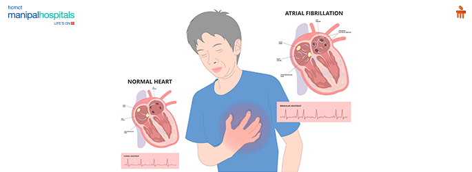 irregular heartbeat causes
