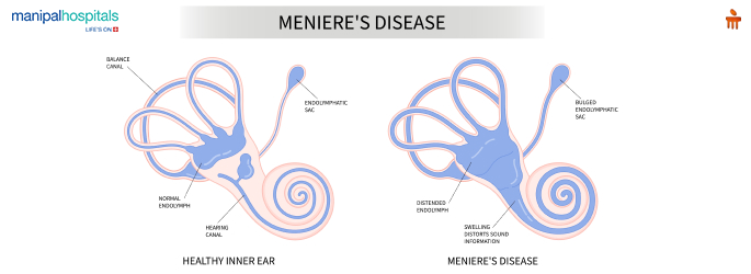 Patient experiencing vertigo and hearing issues due to Meniere’s disease, receiving care at Manipal Hospitals Baner