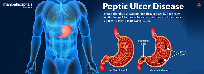 symptoms of peptic ulcers in stomach