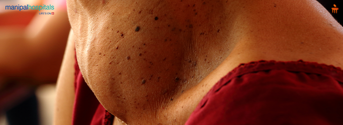 thyroid nodules