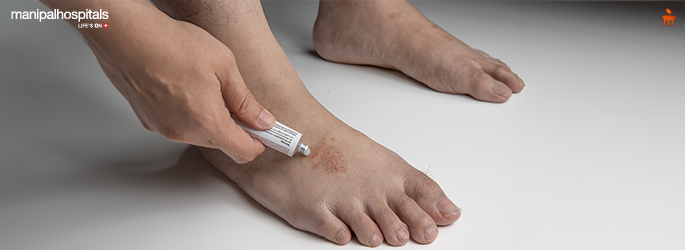 Tinea Fungal Infection: Causes, Spread & Prevention Tips