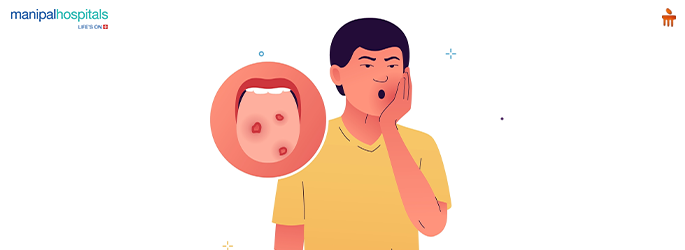 tongue ulcer treatment