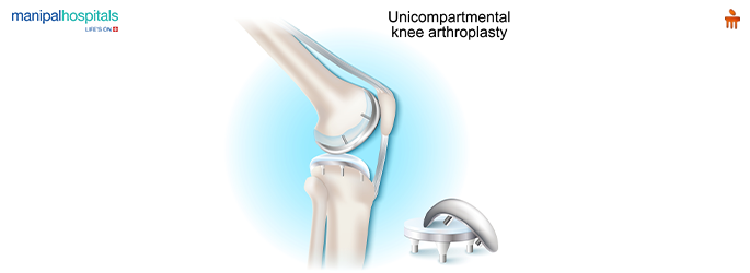 total-knee-replacement-surgery