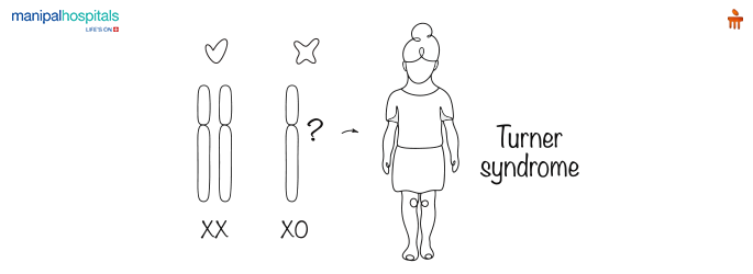 Turner Syndrome Explained: Causes, Symptoms, Diagnosis and Treatment