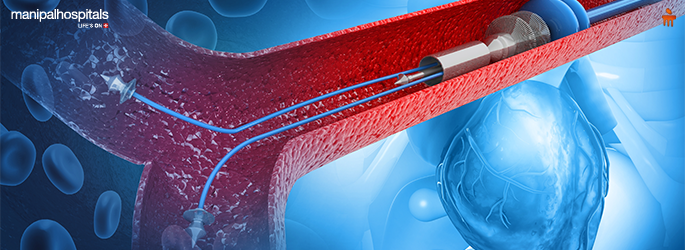 Types of Angioplasty