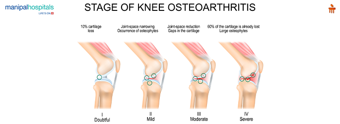 Understanding Joint Inflammation and Swelling