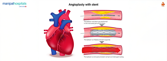 Unlocking The Potential Of Angioplasty In Cardiac Science