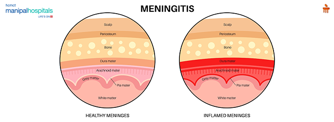 Warning Signs of a Spinal Infection