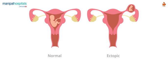 What are the Causes of Ectopic Pregnancy