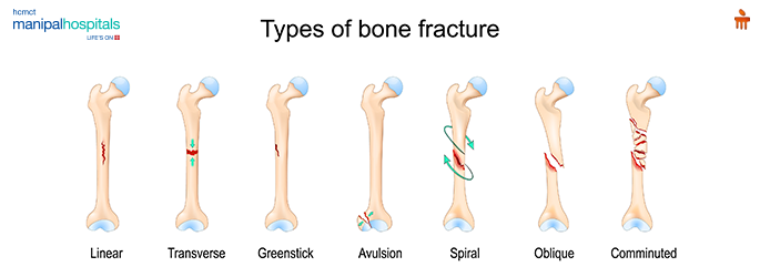 wrist fracture treatment