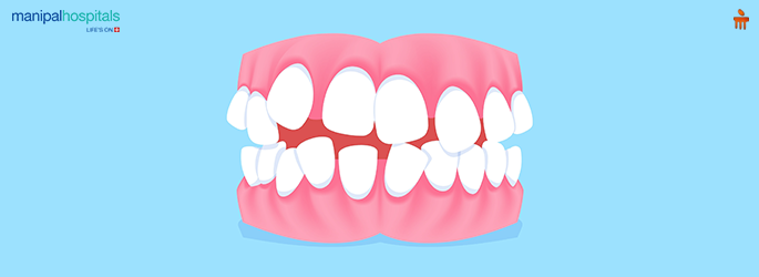 चुकीच्या पद्धतीने जुळवलेल्या दातांची गर्दी